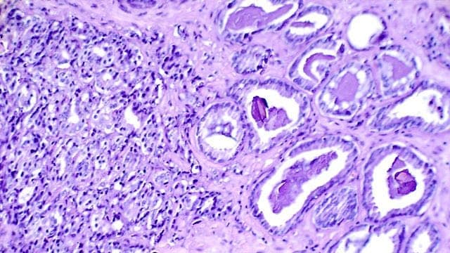 New Hope for Fighters: Promising Drug Combo Tackles Advanced Prostate Cancer