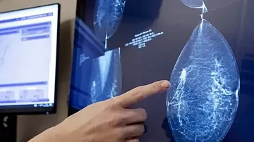AI Breakthrough: Predicting Breast Cancer Risk—Finally, a Crystal Ball for Your Health!
