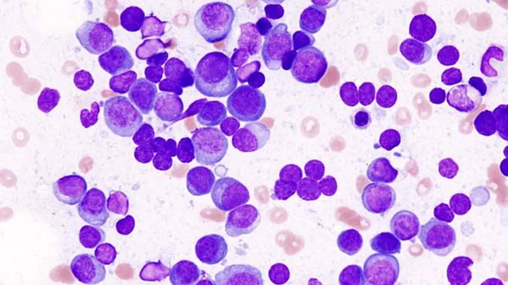 Revolutionizing Cancer Treatment: T-Cells Created Right Inside Patients!