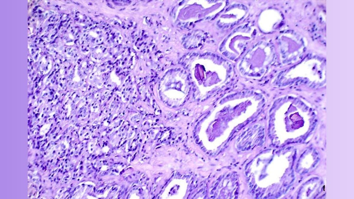 New Hope for Fighters: Promising Drug Combo Tackles Advanced Prostate Cancer