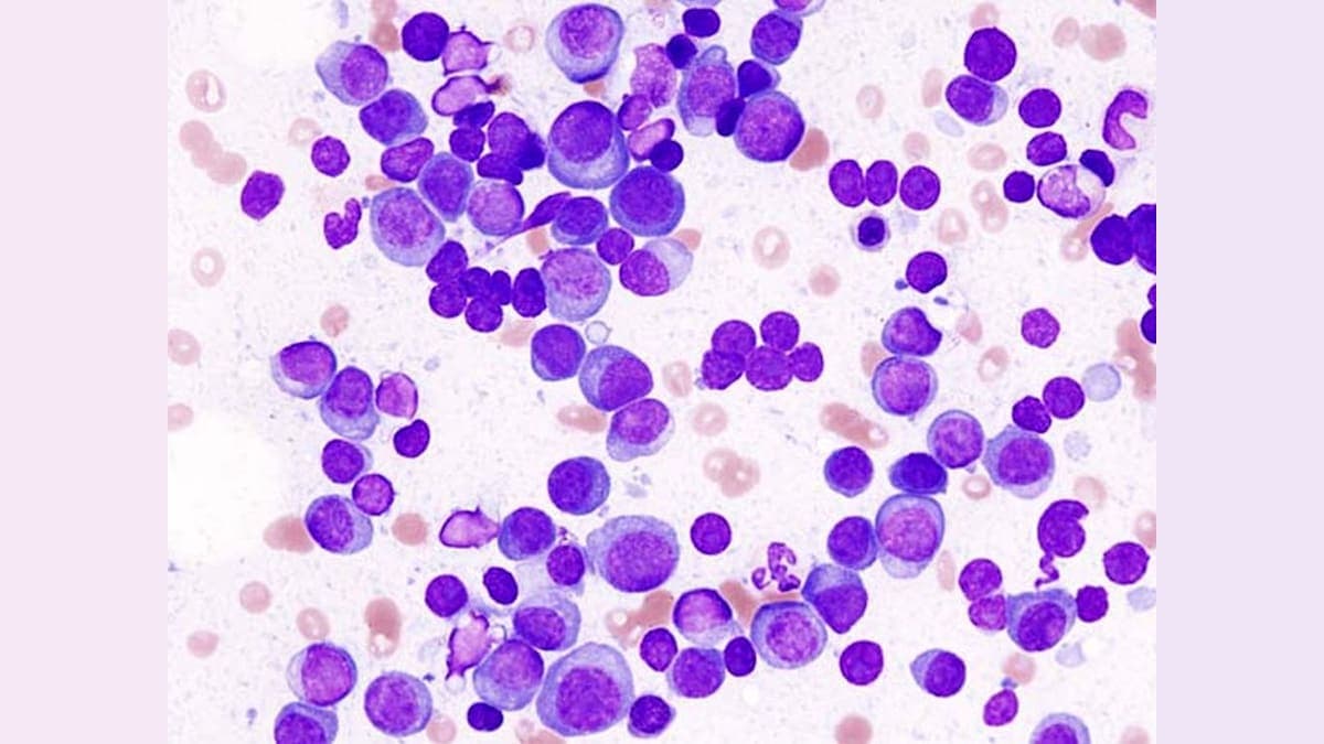 Revolutionizing Cancer Treatment: T-Cells Created Right Inside Patients!