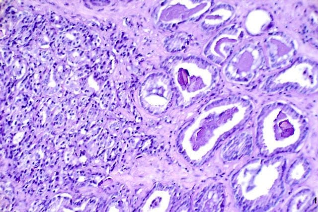 New Hope for Fighters: Promising Drug Combo Tackles Advanced Prostate Cancer
