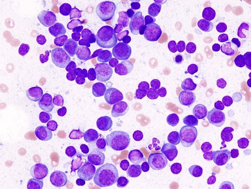 Revolutionizing Cancer Treatment: T-Cells Created Right Inside Patients!